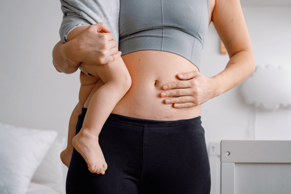 Recovery After a Caesarean Section: What to Expect and How to Care for Yourself