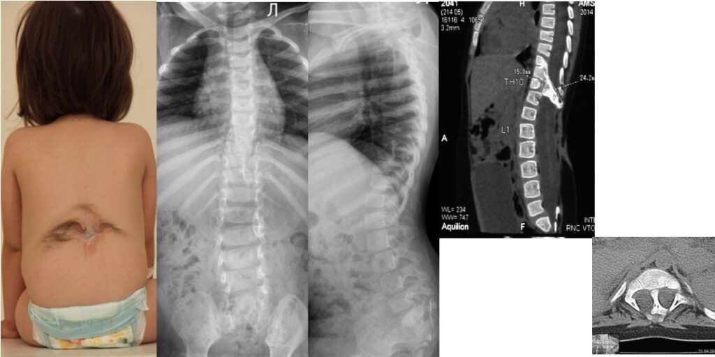 Understanding Spina Bifida