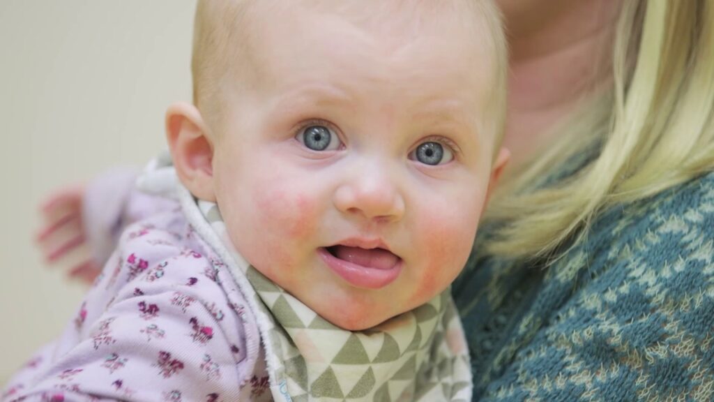Understanding Cleft Lip and Palate: Diagnosis, Treatment, and Support